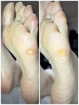 カーム(CALM)/魚の目・タコでお悩みの方必見