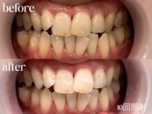 ホワイトニングカフェ 仙台八幡店/10回照射後