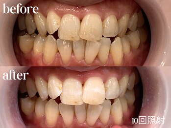 ホワイトニングカフェ 仙台八幡店/10回照射後