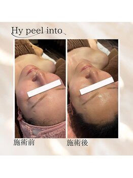 ココリ(CoCoRe)/東北初導入！Hy peel into