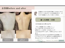 エミルカ 鹿児島店(EMILUCA)/ハーブピーリング