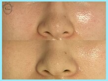 ヴィオール 名古屋栄店(VIOR)/毛穴つまりにお悩みならコレ！