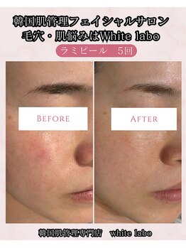 ホワイトラボ 梅田(White labo)/【施術例】ラミピール