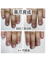 マニュコクーン(ManuCocoon)/爪育成　深爪　巻き爪　大阪市
