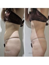 ラクト サロン(RAKT salon)/脂肪冷却４カップ 脇腹 上下腹部