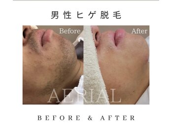 エアリアル 八女店/青髭卒業で清潔感アップ！
