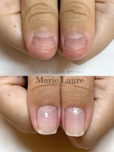 マリーロール 梅田店(Marie Laure)/深爪矯正/自爪育成/自爪風
