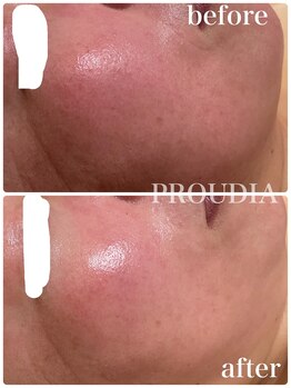 プラウディア(PROUDIA)/ハーブピーリング/凸凹跡ケア
