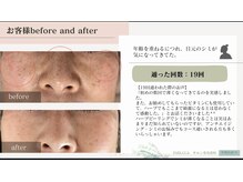 エミルカ 鹿児島店(EMILUCA)/ハーブピーリング