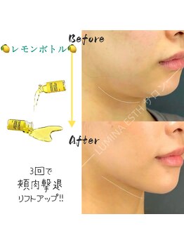 ルミナエステ(LUMINA ESTH)/脂肪分解剤レモンボトル