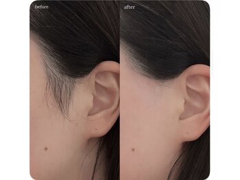 ハッピーアロマサロン(Happy aroma salon)の写真/VIOの悩み解消！全身ワックス＋光脱毛で、なめらか美肌を体験☆自己処理いらず♪