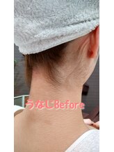 エステシェービングサロン フルール(Fleur)/うなじのビフォーアフター