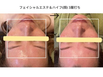 ディアレスト(Dearest)/ハイフ(顔)＋フェイシャルエステ