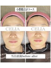 セリア(CELIA)/小顔矯正/小顔//面長/エラ張り