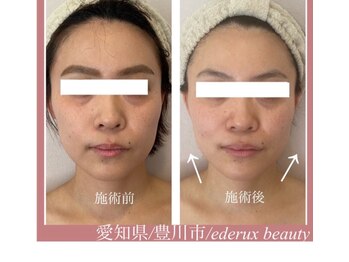 エデルビューティー(ederux beauty)/コルギ