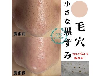 毛穴屋/毛穴洗浄毛穴エクストラクション