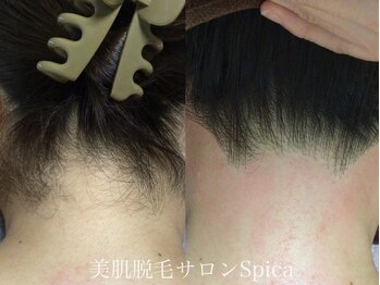 スピカ(SPICA)/ミックス脱毛でより綺麗に