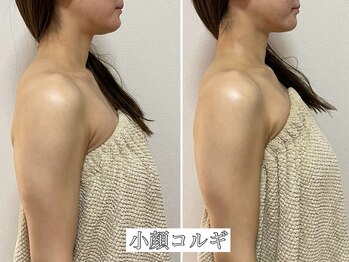 イデアルミー 大宮店(イデアルMe)/小顔コルギ2回目施術のお客様