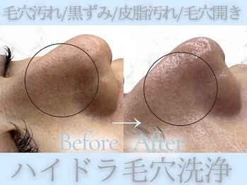 Cスキンケアクリニック 麻布店/毛穴洗浄ハイドラフェイシャル