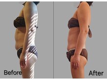 オリジナル筋膜1回の変化です！姿勢とぽっこりお腹の改善！