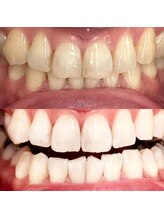 シエル(CIEL)/医療提携セルフホワイトニング