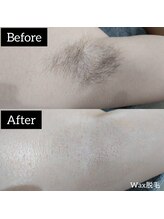 ジュゴン(Dugong)/脇脱毛（Before＆After）