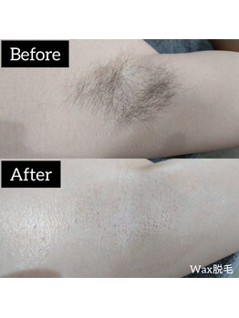 ジュゴン(Dugong)/脇脱毛（Before＆After）