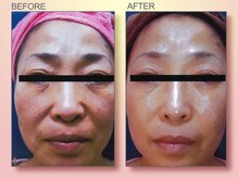 ジュリア オージェ 京橋店/ビフォーアフター/イドラリフト