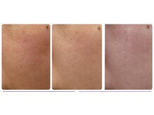 ヴィオール 名古屋栄店(VIOR)/ハーブピーリング