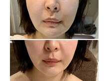 インディバ ミマリ(INDIBA ミマリ)の雰囲気（上下顎の術後ケア3回（個人差あり））