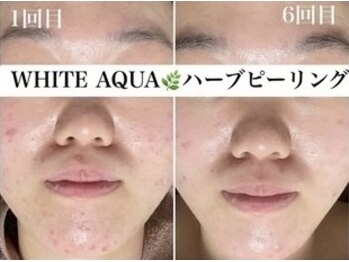 ホワイトアクア 四日市店(WHITE AQUA)/肌悩み/ハーブピーリング