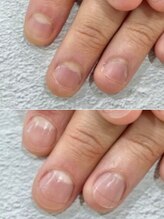 リファーレ(RIFARE)/【深爪矯正】長さだし有◎