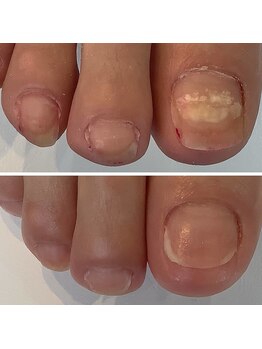 フットファースト 名古屋池下店/目立たないドイツ製矯正テープ