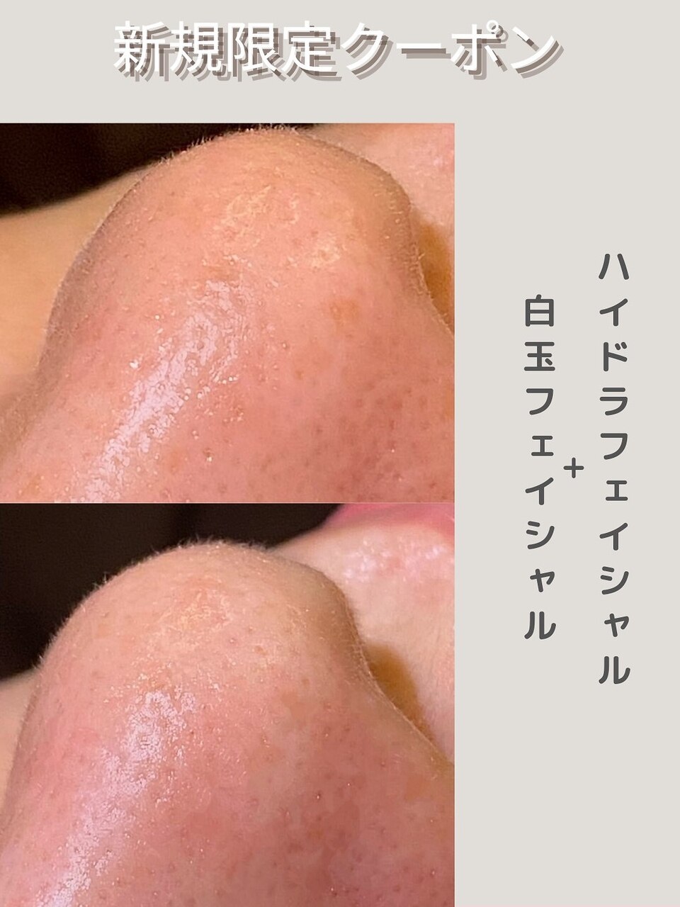 【汗ばむ季節の毛穴洗浄×強力美白効果】ハイドラ＋白玉フェイシャル\11000