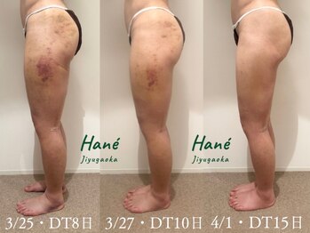 ハネ 自由が丘(Hane)の写真/【自由ヶ丘初・術後特化店】浮腫み/硬さ/動かしづらさを改善！プロの知識×術後経験者が完全カスタマイズ◎