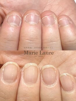 マリーロール 梅田店(Marie Laure)/自爪育成/深爪矯正/ネイルケア