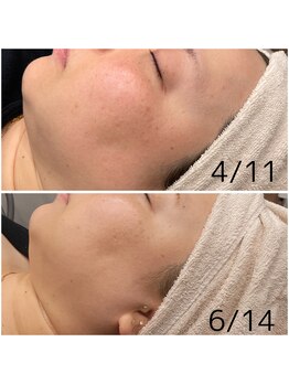 ココ(Coco)/シミケア