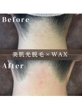 エピナ 横浜店(Epina)/うなじMIX脱毛☆