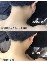 ホッコリ 段原店(HOKKORI)/うなじ脱毛