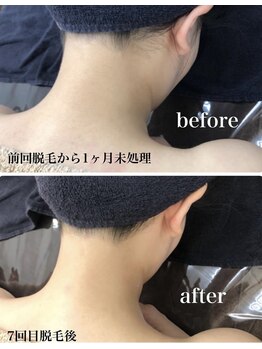 ホッコリ 段原店(HOKKORI)/うなじ脱毛