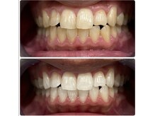 エクシアホワイト 立川南口店/セルフホワイトニング効果事例