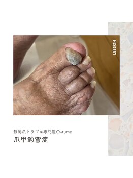 オツメ 静岡(O-tume)/爪甲鉤弯