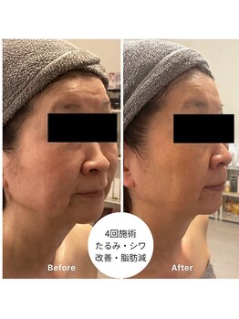 フワリ(fuwari)の写真/【ほうれい線・たるみ】年齢影に悩まない!本格肌改善×未来の老け見えを防ぐ徹底予防ケア