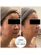 フワリ(fuwari)の写真/【ほうれい線・たるみ】年齢影に悩まない!本格肌改善×未来の老け見えを防ぐ徹底予防ケア