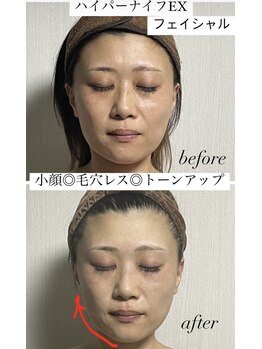 アローナ(ARONA)/ハイパーナイフEXフェイシャル