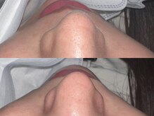 ウー(Wu)/wax脱毛(鼻)