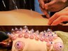 【首肩コリや背中、腰の張りに】プチ鍼付きカッピング(スタンダード)吸玉療法