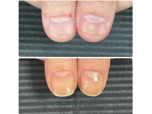 ルカロンネイル(Rukaron Nail)/凸凹爪＋深爪