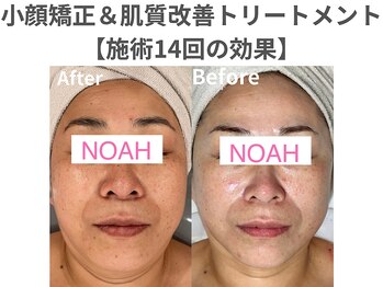 ノア 川越店(NOAH)/肌質改善・小顔