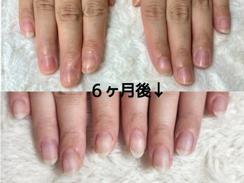 グラシナ なんば店/深爪/自爪育成/フィルイン